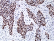 IHC staining of FFPE human lung squamous cell carcinoma tissue with recombinant SOX2 antibody at 1:100.