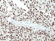 IHC staining of FFPE human glioblastoma tissue with recombinant SOX2 antibody at 1:100.