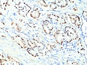 IHC staining of FFPE human prostate cancer tissue with recombinant NKX3.1 antibody at 1:200.