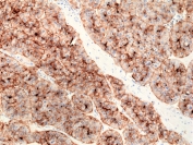 IHC staining of FFPE human liver cancer tissue with recombinant CD73 antibody at 1:200.