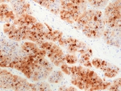 IHC staining of FFPE human liver cancer tissue with recombinant HSP70 antibody at 1:500.