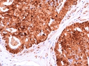 IHC staining of FFPE human breast cancer tissue with recombinant HSP70 antibody at 1:200.