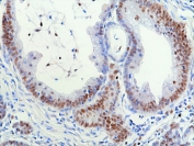 IHC staining of FFPE human colon cancer tissue with recombinant Ribonuclease H2 subunit B antibody at 1:100.