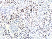 IHC staining of FFPE human lung cancer tissue with recombinant Ribonuclease H2 subunit B antibody at 1:100.