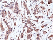 IHC staining of FFPE human breast cancer tissue with recombinant P70 S6 Kinase antibody at 1:400.