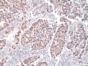 IHC staining of FFPE human brain cancer tissue with recombinant P70 S6 Kinase antibody at 1:100.