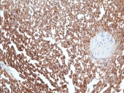IHC staining of FFPE human gastrointestinal stroma tissue with recombinant DOG1 antibody at 1:100.