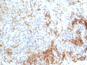 IHC staining of FFPE human lung cancer tissue with recombinant TIM-3 antibody at 1:200.