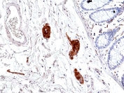 IHC staining of FFPE human colon tissue with recombinant Phosphorylated Tau antibody at 1:50.
