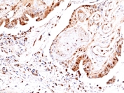 IHC staining of FFPE human colon cancer tissue with recombinant phosphorylated JNK antibody at 1:100.