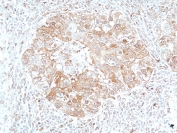 IHC staining of FFPE human lung cancer tissue with recombinant STAT3 antibody at 1:50.