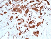IHC staining of FFPE human breast cancer tissue with recombinant STAT3 antibody at 1:200.