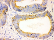 IHC testing of FFPE human intestinal cancer tissue with Bcl-2 antibody. HIER: Boil the paraffin sections in pH 6, 10mM citrate buffer for 20 minutes and allow to cool prior to testing.