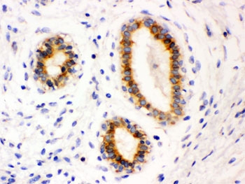 IHC testing of FFPE human breast cancer tissue with Bcl-2 antibody. HIER: Boil the paraffin sections in pH 6, 10mM citrate buffer for 20 minutes and allow to cool prior to testing.