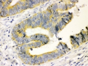 IHC testing of FFPE human intestinal cancer tissue with Calbindin antibody. HIER: Boil the paraffin sections in pH 6, 10mM citrate buffer for 20 minutes and allow to cool prior to testing.