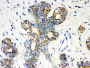 IHC testing of FFPE human breast cancer tissue with Calbindin antibody. HIER: Boil the paraffin sections in pH 6, 10mM citrate buffer for 20 minutes and allow to cool prior to testing.
