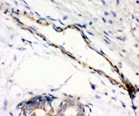 IHC testing of FFPE human breast cancer with Caldesmon antibody (clone CD-7). HIER: steamed with pH6 citrate buffer.~