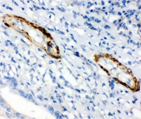 IHC testing of FFPE human intestinal cancer with Caldesmon antibody (clone CD-7). HIER: steamed with pH6 citrate buffer.