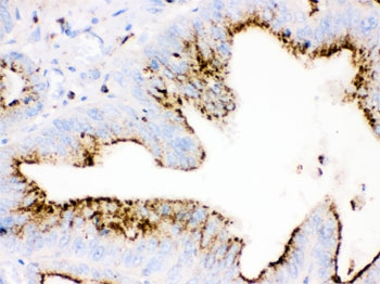 IHC testing of FFPE human intestinal cancer tissue with Cathepsin D antibody. HIER: steamed with pH6 citrate buffer, HRP-staining.
