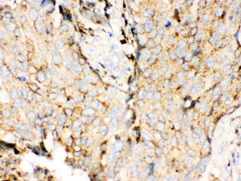 IHC testing of FFPE human breast cancer tissue with Cathepsin D antibody. HIER: steamed with pH6 citrate buffer, HRP-staining.