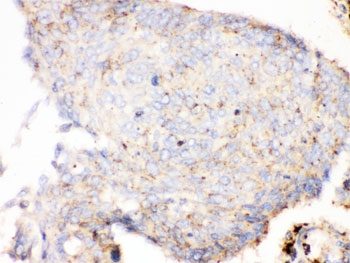 IHC testing of FFPE human lung cancer tissue with Cathepsin D antibody. HIER: steamed with pH6 citrate buffer, HRP-staining.