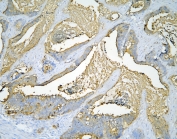 IHC staining of FFPE human intestinal cancer with CEA antibody at 1ug/ml. HIER: boil tissue sections in pH6, 10mM citrate buffer, for 10-20 min and allow to cool before testing.