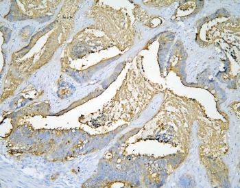 IHC staining of FFPE human intestinal cancer with CEA antibody at 1ug/ml. HIER: boil tissue sections in pH6, 10mM citrate buffer