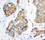 IHC staining of FFPE human breast cancer tissue with Cytokeratin 18 antibody. HIER: boil tissue sections in pH8 EDTA for 20 min and allow to cool before testing.