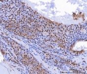 IHC staining of FFPE human thyroid cancer tissue with c-Myc antibody. HIER: boil tissue sections in pH8 EDTA for 20 min and allow to cool before testing.