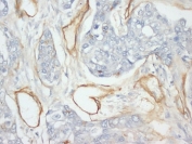 IHC-P: Collagen IV antibody testing of human breast cancer tissue. HIER: steamed with pH6 citrate buffer, HRP-staining. 