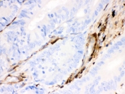 IHC testing of FFPE human intestinal cancer tissue with Gelsolin antibody. HIER: steamed with pH6 citrate buffer, HRP-staining.