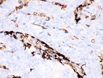 IHC testing of FFPE human lung cancer tissue with Gelsolin antibody. HIER: steamed with pH6 citrate buffer, HRP-staining.~