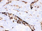 IHC testing of FFPE human lung cancer tissue with Gelsolin antibody. HIER: steamed with pH6 citrate buffer, HRP-staining.