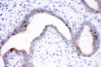 IHC staining of FFPE human breast cancer tissue with HSP70 antibody. HIER: boil tissue sections in pH8 EDTA for 20 min and allow to cool before testing.~