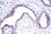IHC staining of FFPE human breast cancer tissue with HSP70 antibody. HIER: boil tissue sections in pH8 EDTA for 20 min and allow to cool before testing.