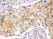 IHC staining of FFPE human lung cancer tissue with Involucrin antibody. HIER: boil tissue sections in pH8 EDTA for 20 min and allow to cool before testing.
