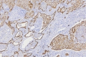 IHC staining of FFPE human lung cancer tissue with pan Cytokeratin antibody. HIER: boil tissue sections in pH8 EDTA for 20 min and allow to cool before testing.