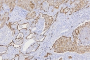 IHC staining of FFPE human lung cancer tissue with pan Cytokeratin antibody. HIER: boil tissue sections in pH8 EDTA for 20 min and allow to cool before testing.