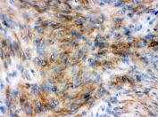 IHC testing of FFPE human meningeoma tissue with Synaptophysin antibody. HIER: Boil the paraffin sections in pH 6, 10mM citrate buffer for 20 minutes and allow to cool prior to testing.