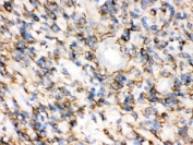 IHC testing of FFPE human glioma tissue with Synaptophysin antibody. HIER: Boil the paraffin sections in pH 6, 10mM citrate buffer for 20 minutes and allow to cool prior to testing.