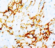 IHC-P: Tenascin antibody testing of human breast cancer tissue. HIER: steamed with pH6 citrate buffer, HRP-staining.