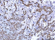 IHC staining of FFPE human invasive urothelial carcinoma tissue with Vimentin antibody. HIER: boil tissue sections in pH8 EDTA for 20 min and allow to cool before testing.