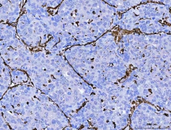 IHC staining of FFPE human liver cancer tissue with Vimentin antibody. HIER: boil tissue sections in pH8 EDTA for 20 min and allow to cool before testing.