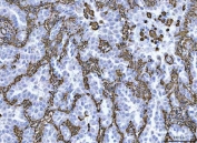 IHC staining of FFPE human lung adenocarcinoma tissue with Vimentin antibody. HIER: boil tissue sections in pH8 EDTA for 20 min and allow to cool before testing.