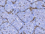 IHC staining of FFPE human liver cancer tissue with Vimentin antibody. HIER: boil tissue sections in pH8 EDTA for 20 min and allow to cool before testing.