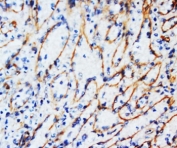 IHC-P: Vimentin antibody testing of human breast cancer tissue. HIER: steam section in pH6 citrate buffer for 20 min.