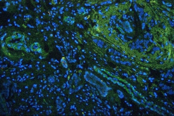 Immunofluorescent staining of FFPE human breast cancer with Vinculin antibody (green) and DAPI (blue). HIER: boil tissue sections in pH6, 10mM citrate buffer, for 20 min and allow to cool before testing.
