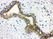 IHC testing of FFPE human breast cancer tissue with alpha-Actinin antibody at 1.5ug/ml. Required HIER: boil the sections in 10mM Citrate buffer, pH6, and allow to cool prior to staining.