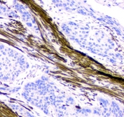 IHC staining of FFPE human esophagus squama cancer tissue with ACTA2 antibody. HIER: boil tissue sections in pH8 EDTA for 20 min and allow to cool before testing.
