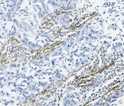 IHC staining of FFPE human lung cancer tissue with ACTA2 antibody. HIER: boil tissue sections in pH8 EDTA for 20 min and allow to cool before testing.